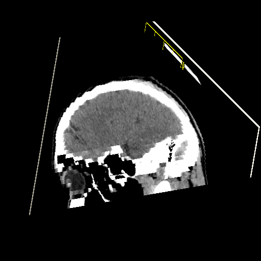 Diagonal slice of 3D volume formed by stacked MRI images.